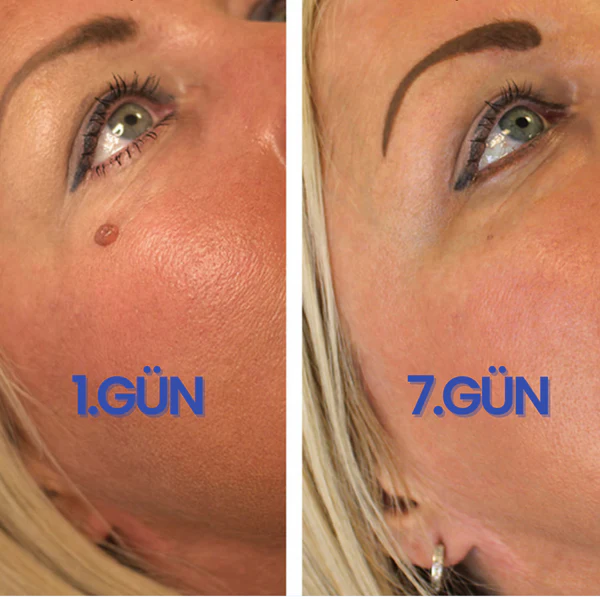 ClearBen™ Et Beni Temizleme Kiti