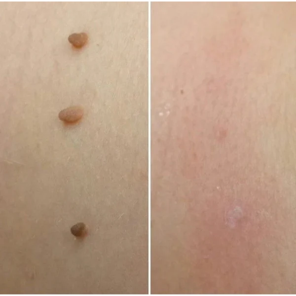 ClearBen™ Et Beni Temizleme Kiti