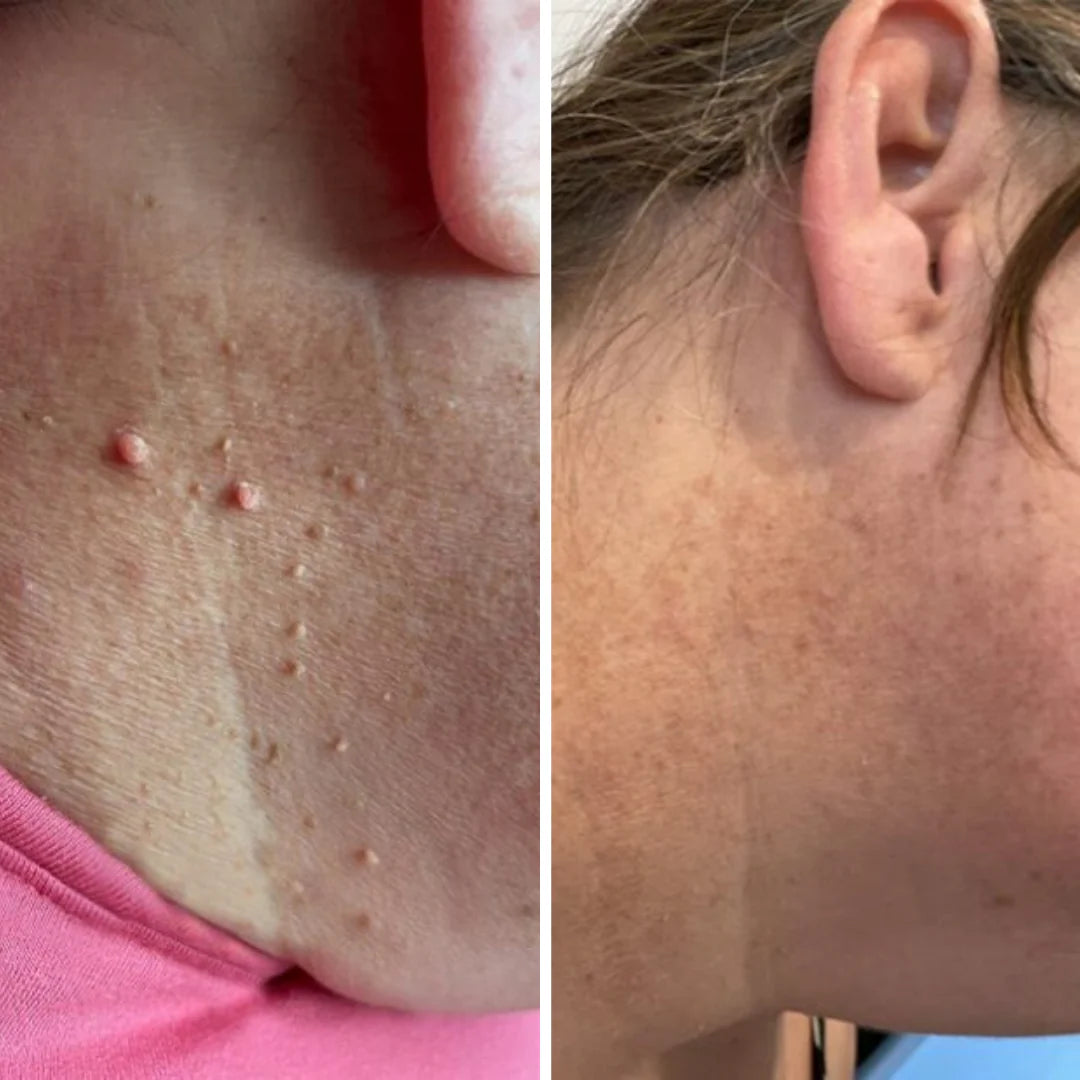 ClearBen™ Et Beni Temizleme Kiti